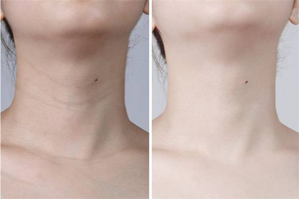 颈纹是怎么引起的，颈纹怎么消除简单的方法