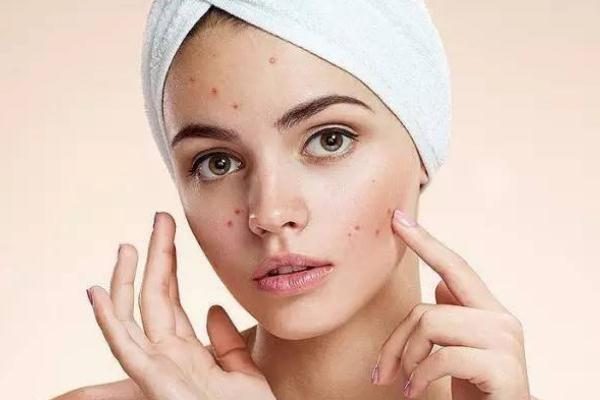 粉刺会留下痘印么，粉刺会长在哪些地方