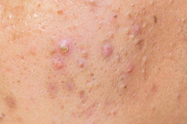 粉刺有脓包怎么处理，粉刺有白色的脓要不要挤掉