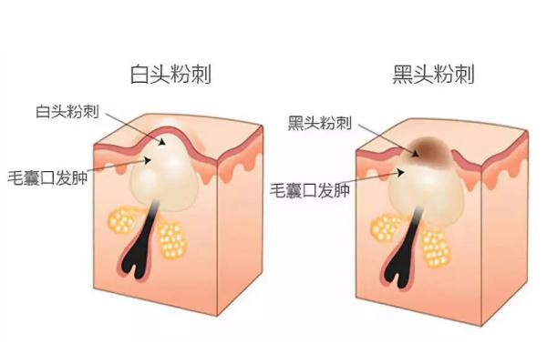 粉刺的正确处理方法，粉刺的白色东西是什么