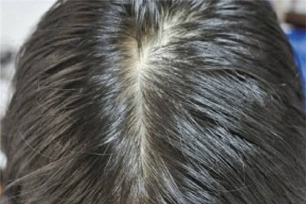 油性头发可以用护发精油吗，油性头发用护发精油好不好