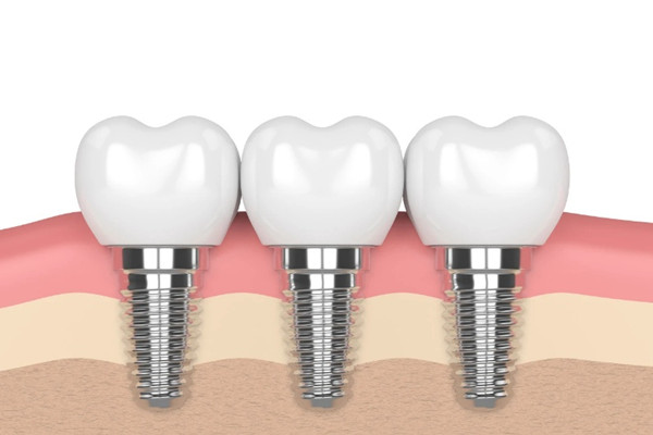 种植牙后多久能吃东西，种植牙后怎么刷牙