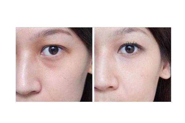 眼袋可以针灸治疗吗，眼袋可以按摩去除吗