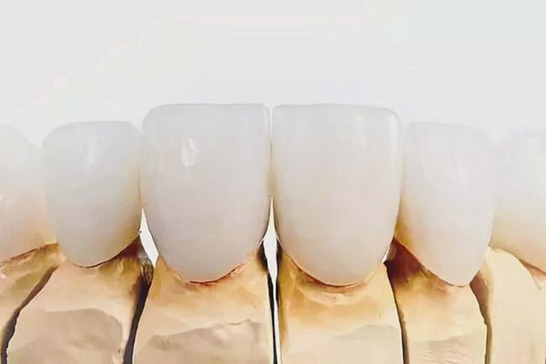 烤瓷牙需要磨牙吗，烤瓷牙需要更换吗
