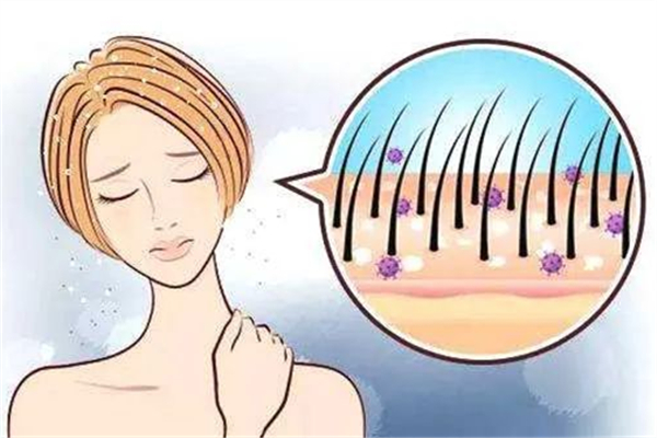 头屑很多大块是什么原因，大块头皮屑怎么治