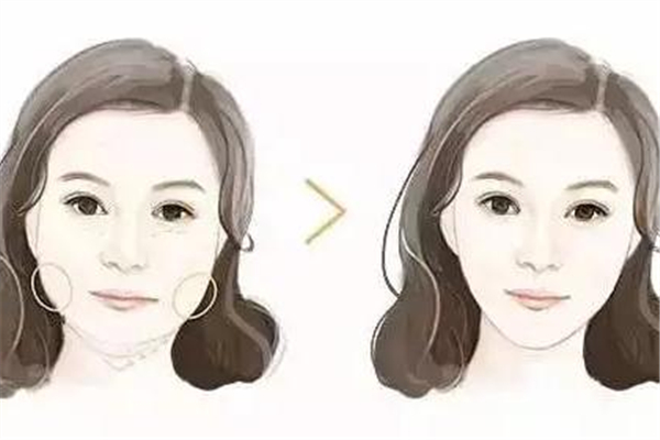 法令纹会彻底消除吗，天生的法令纹能去掉吗