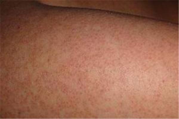 鸡皮肤要补充什么维生素，鸡皮肤吃什么能改善