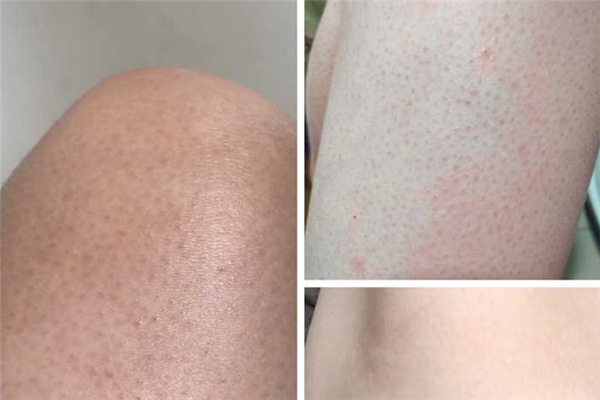 鸡皮肤激光可以根治吗，鸡皮肤激光治疗多少钱