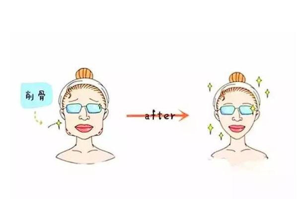 削骨瘦脸风险大吗，削骨瘦脸多久可以恢复
