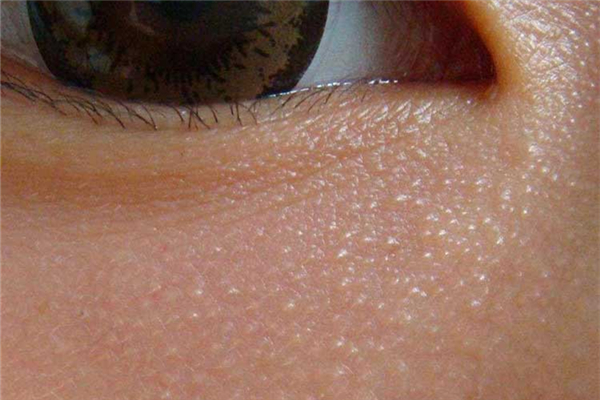 ​脂肪粒去除了还会长吗，脂肪粒怎么预防