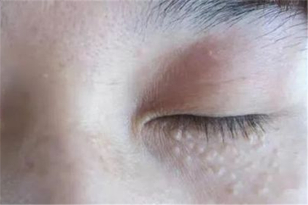 脂肪粒去医院去除需要多少钱，脂肪粒去医院去除还是去美容院去除