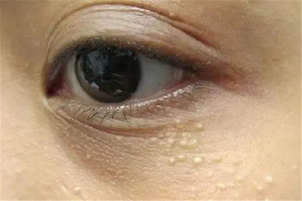 脂肪粒如何去除，脂肪粒形成的主要原因