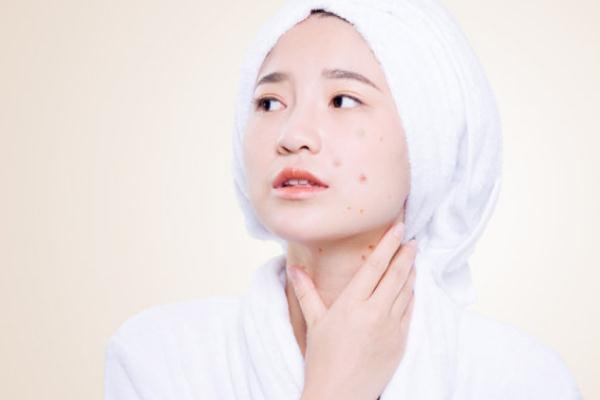 刷酸爆痘之后怎么办，刷酸可以祛痘印吗