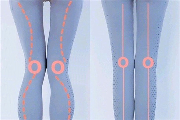 腿型不直可以矫正吗，腿型不直怎么矫正