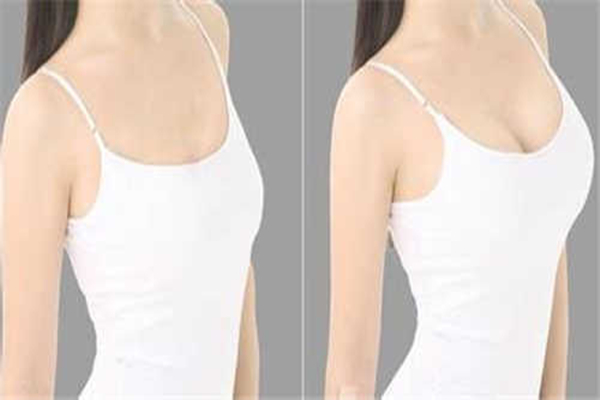 丰胸手术风险大吗，丰胸手术对身体有什么影响