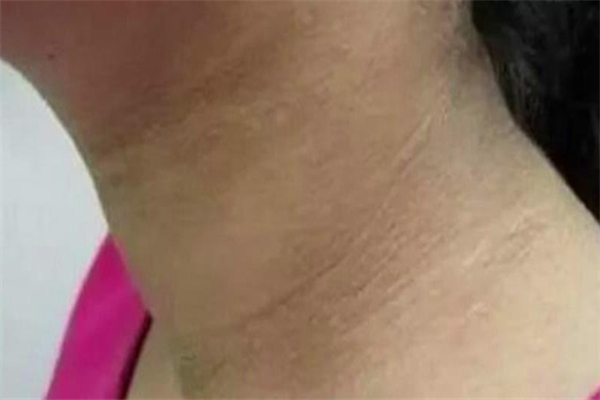 脖子黑黑的洗不掉是什么原因，脖子黑黑的怎么洗干净
