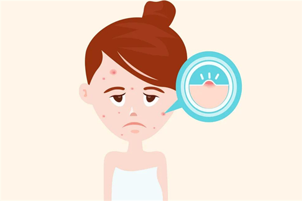 夏季脸上出油长痘怎么办，夏季皮肤出油严重怎么办