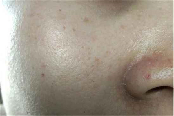 鼻子两侧毛孔粗大原因及怎么改善，原因及护理方法说明