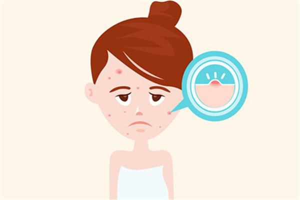 痘痘肌适合用什么洗面奶，痘痘肌肤怎么调理小常识