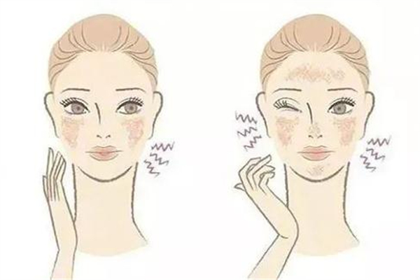 敏感肌可以涂防晒吗，敏感肌涂防晒霜会过敏吗