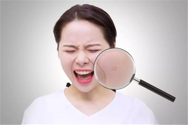 夏天脸上长痘痘怎么回事，为什么夏天脸上爱长痘