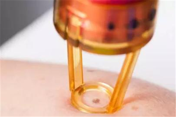 点痣有风险吗，点痣需要注意哪些事项