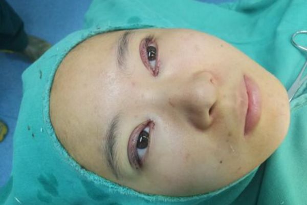 肿眼泡可以割双眼皮吗，肿眼泡能割双眼皮吗