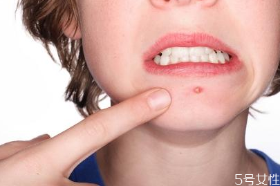 戴口罩下巴长痘痘怎么办，怎样避免戴口罩闷痘