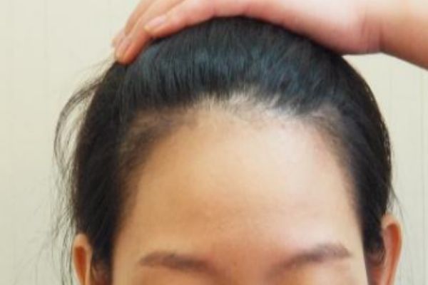 怎么样让发际线变低，如何让发际线前移