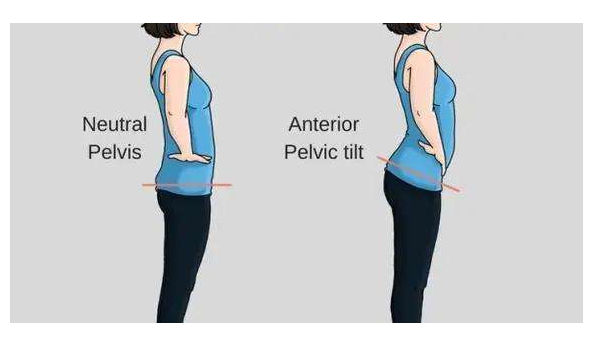 骨盆前倾是怎么造成的，什么睡姿可以矫正骨盆前倾
