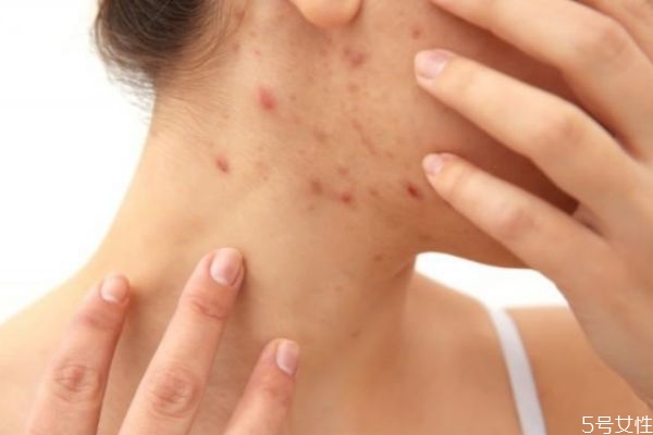 脖子上喜欢长痘痘是怎么回事，脖子上长痘痘原因