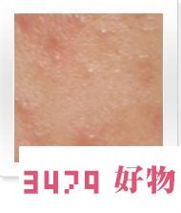 世上最全面治疗痘痘大全