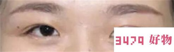 8种双眼皮整容失败症状以及修复