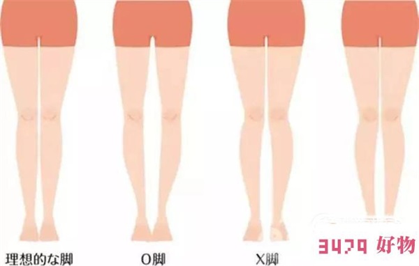 x型腿怎么矫正