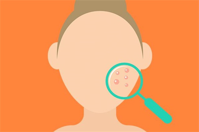 改善脸上痘痘的好方法，这样消除不复发