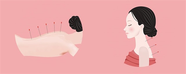 针灸减肥20斤需要多久