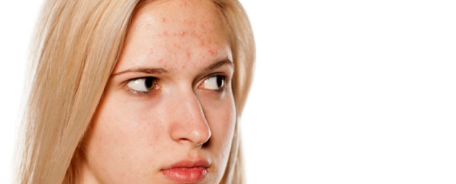 粉刺印怎么去，如何去粉刺印