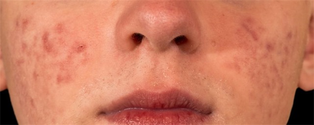  右脸颊长痘是什么原因，右脸颊长痘需要排毒吗