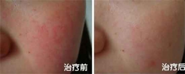 红血丝怎么消除，简单几招调理建议