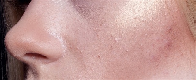 脸上很多粉刺怎么办，长粉刺的护肤方法