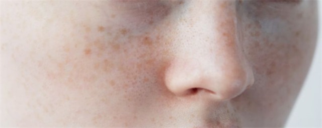 淡斑小妙招有哪些，分享几个淡斑小妙招