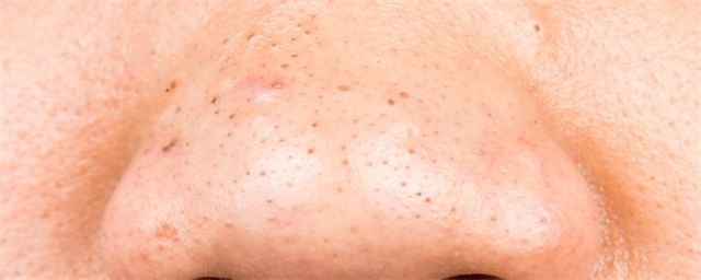 为什么鼻子上有黑头，鼻子黑头多的原因