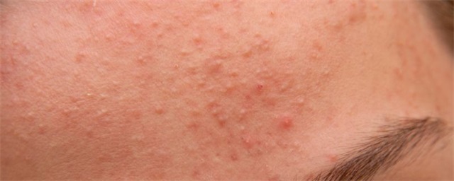 脸上长粉刺的注意事项，脸上长粉刺需要注意什么