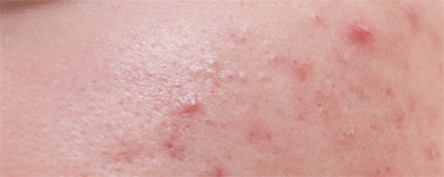 安安粉刺露是什么，安安粉刺露好用吗