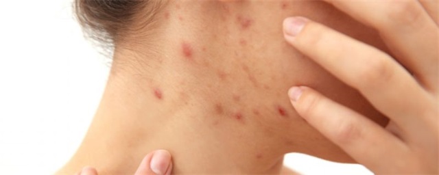 痤疮的症状有哪些，痤疮是什么