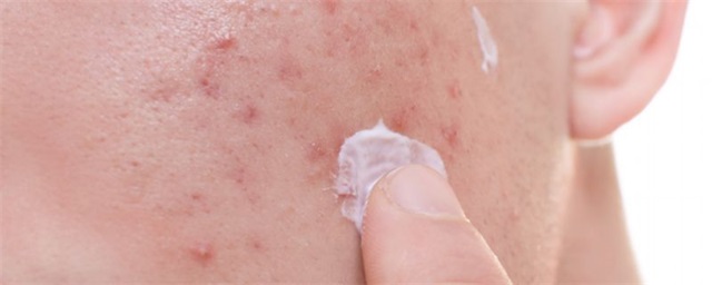  长粉刺适合的隔离霜，有粉刺可以用隔离霜吗