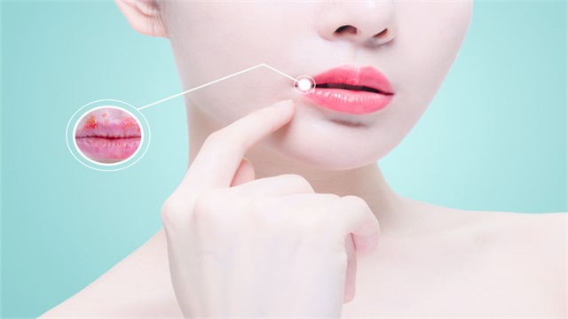 嘴巴干裂出血怎么办，嘴巴干裂出血该如何解决