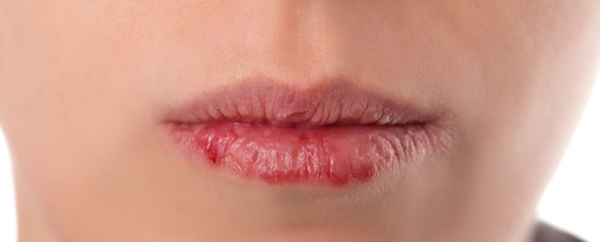 嘴巴干裂起皮怎么治，嘴巴干裂起皮怎么办