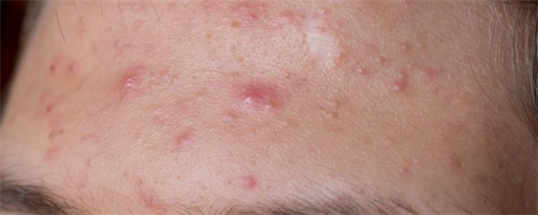 脸上螨虫粉刺应该注意什么，脸上螨虫粉刺怎么办