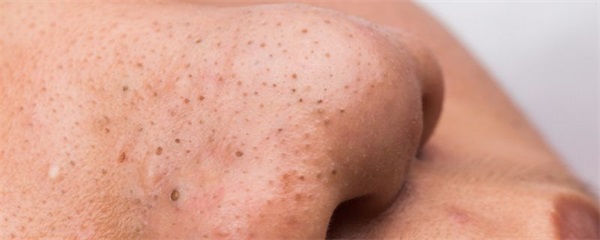 黑头粉刺形成的原因，黑头粉刺是什么